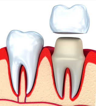 illustration of a dental crown going over a tooth