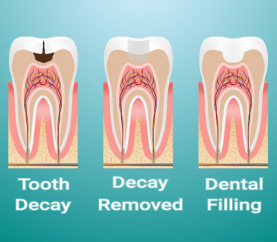 diagram of stages of getting a tooth filling