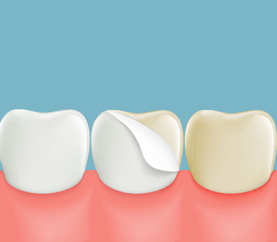 illustration of teeth with veneers on.