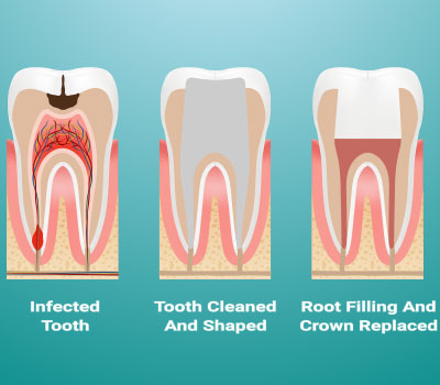 Diagram of stages of a root canal